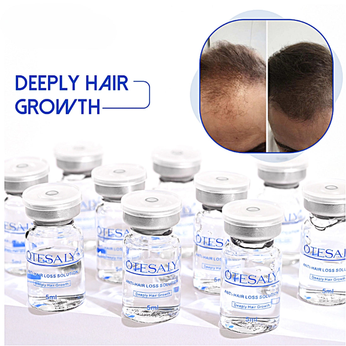Otesaly® Anti-Hair Loss Solution 5ml